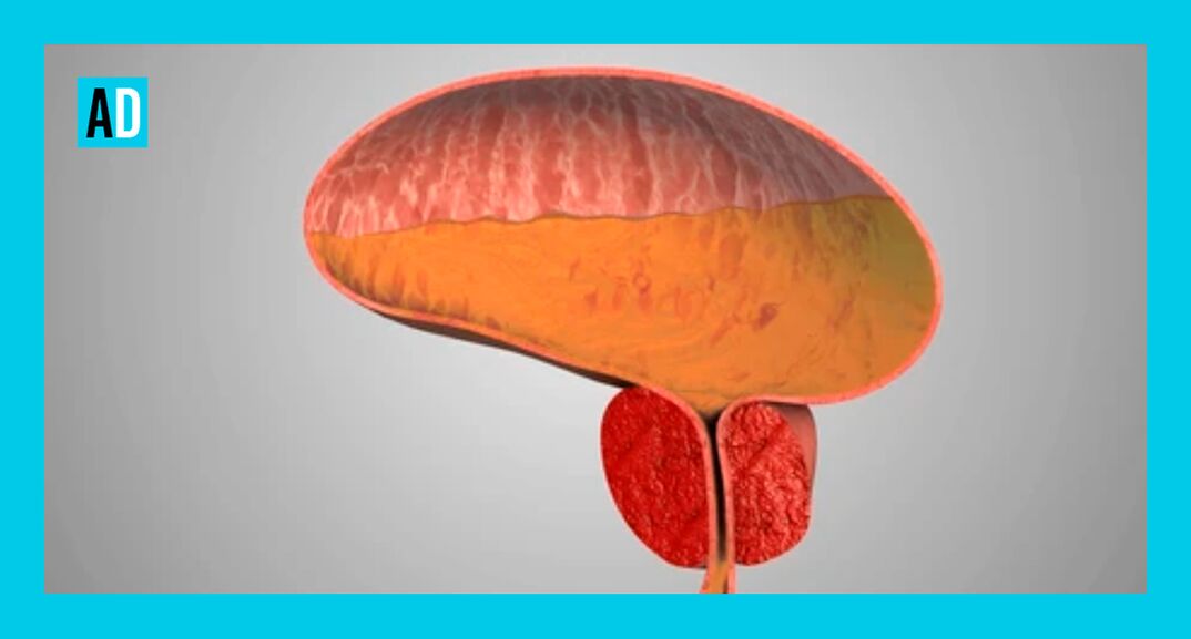 Entzündete Prostata